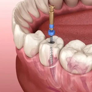 mejor dentista en miami, carillas de porcelana en miami, Botox miami, costo del tratamiento de conducto en miami, elevación de seno nasal en miami, mejores carillas en miami, mejor dentista del sur de florida, mejor dentista cosmético en miami, mejor atención dental en miami, sage dental